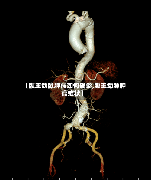 【腹主动脉肿瘤如何确诊,腹主动脉肿瘤症状】-第3张图片