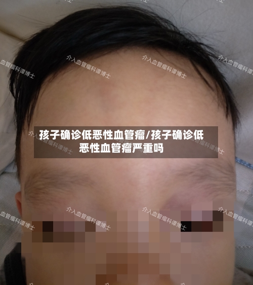 孩子确诊低恶性血管瘤/孩子确诊低恶性血管瘤严重吗
