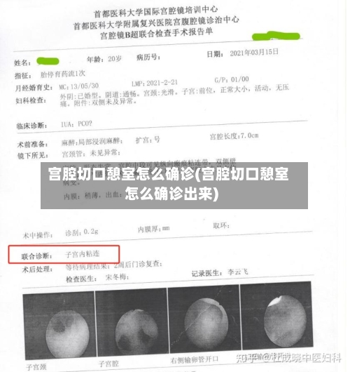 宫腔切口憩室怎么确诊(宫腔切口憩室怎么确诊出来)
